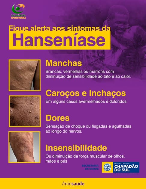 Hanseníase: tudo sobre, sintomas, diagnóstico e tratamento